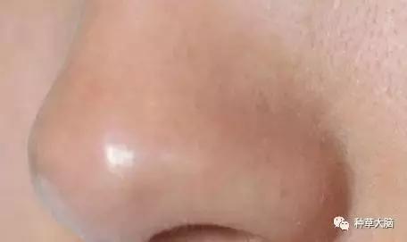 比较温和的去黑头方法,现在比较靠谱的去黑头方法