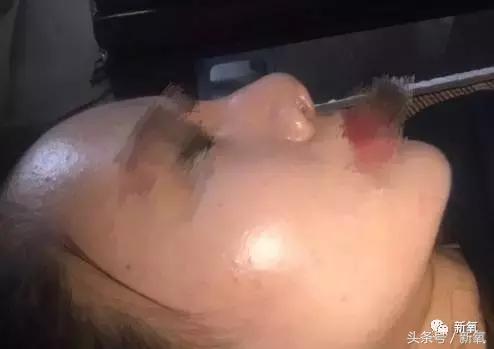 做了个达拉斯隆鼻,假体直接戳到脑门,我是不是和张檬、刘雨欣遇到了同一个医生!