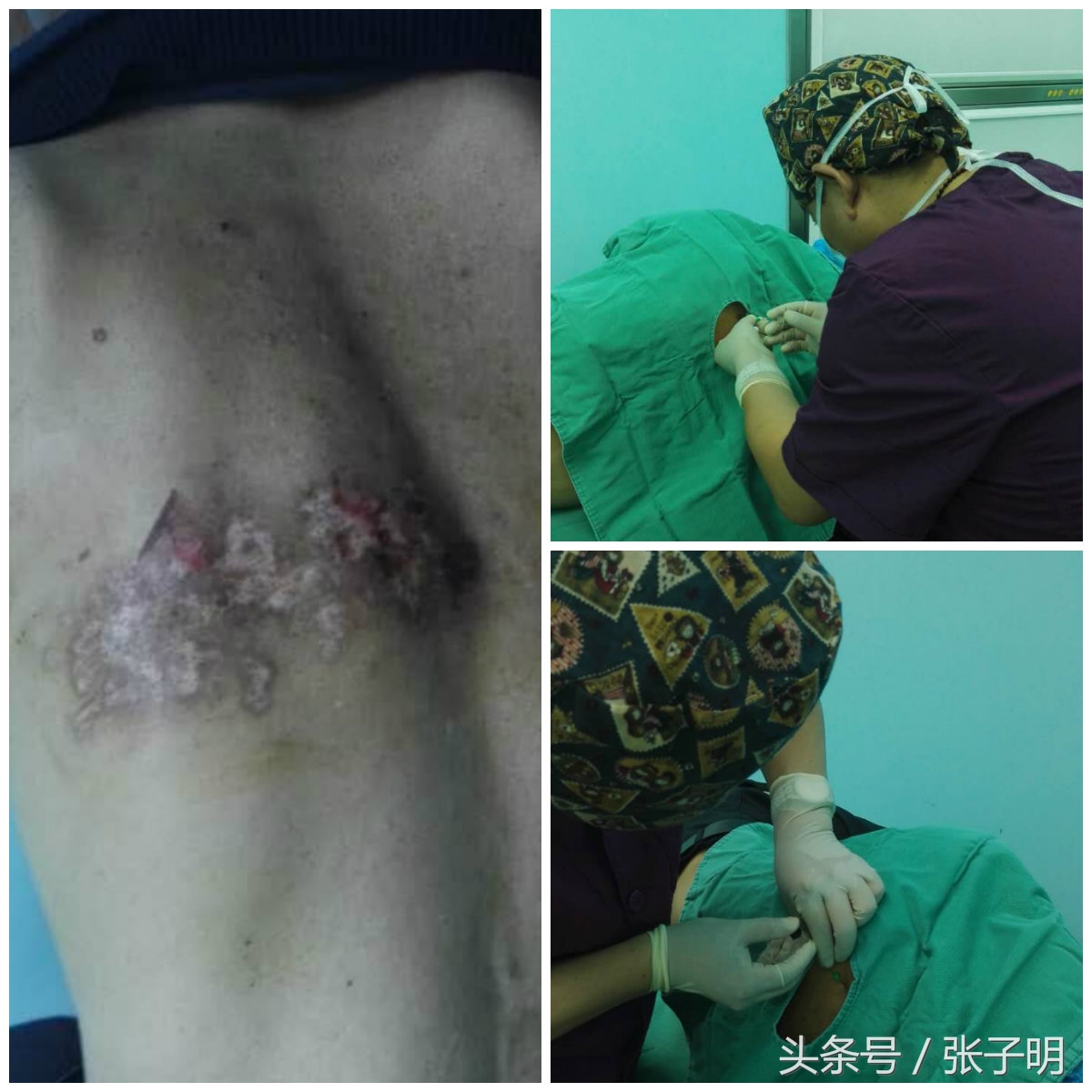 定西市二院疼痛门诊李长文主任妙手回春一针除病