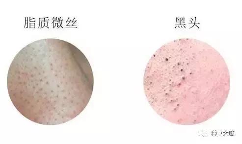 比较温和的去黑头方法,现在比较靠谱的去黑头方法