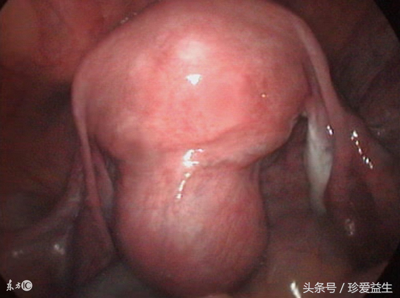 你知道，你已深陷肿瘤的包围圈吗？