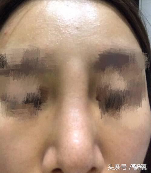 做了个达拉斯隆鼻,假体直接戳到脑门,我是不是和张檬、刘雨欣遇到了同一个医生!