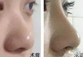 做了个达拉斯隆鼻,假体直接戳到脑门,我是不是和张檬、刘雨欣遇到了同一个医生!