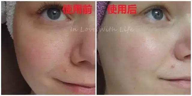 女明星和网红都爱的玻尿酸,保湿、除皱、抗初老,不到百元!