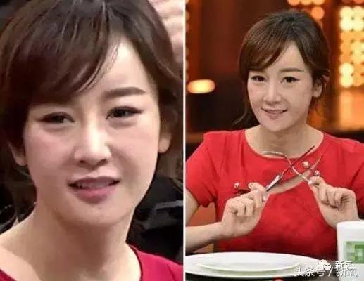 做了个达拉斯隆鼻,假体直接戳到脑门,我是不是和张檬、刘雨欣遇到了同一个医生!