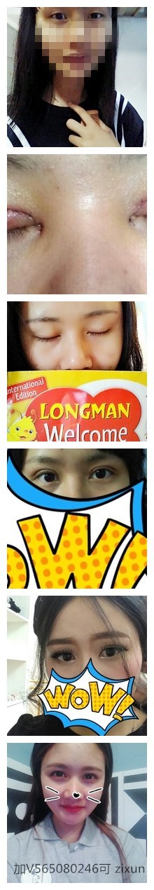 双眼皮松弛全切恢复过程,全切双眼皮几天可以洗脸