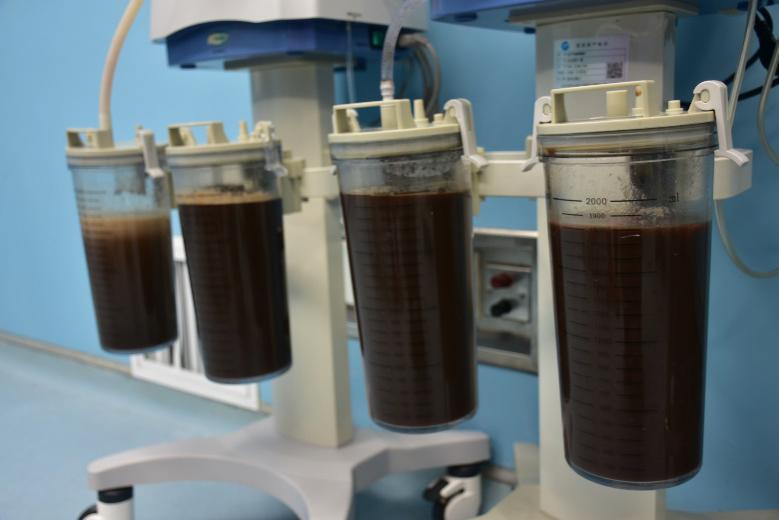 80多岁盆腔巨大囊肿能手术吗,81岁盆腔囊肿建议手术吗