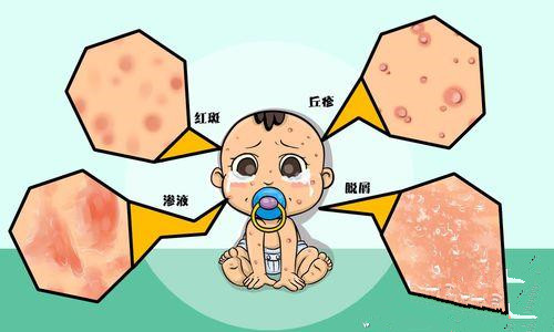 婴儿湿疹怎么办三个妙招来解决,婴儿湿疹最佳治疗小偏方