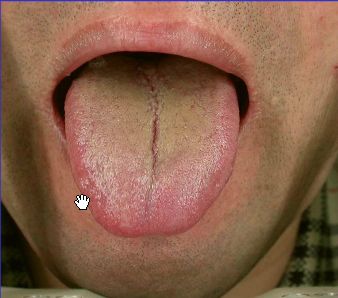 湿气寒热如何区分,湿气重怎么判断是寒湿还是湿热