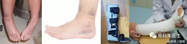 踝关节骨折和踝关节扭伤哪个严重,踝关节扭伤康复治疗注意事项