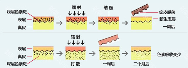 激光夏天做还是冬天做比较好,激光夏天做好还是冬天做好