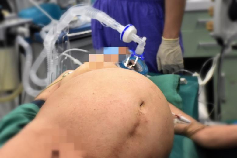 80多岁盆腔巨大囊肿能手术吗,81岁盆腔囊肿建议手术吗