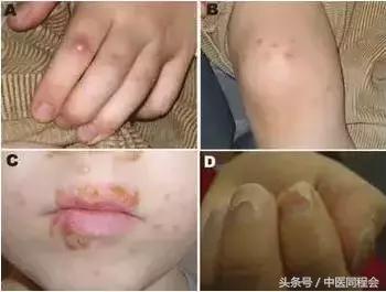 小儿发烧呼吸粗重,郭生白各种发烧的治法