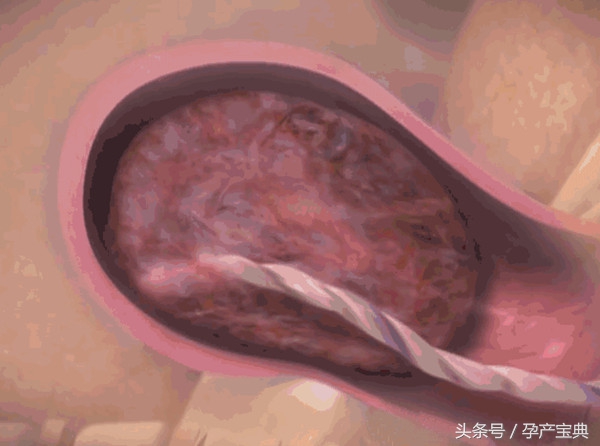 妇产科医生讲解整个分娩过程,妇产科产程讲解