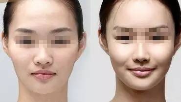 娱乐圈不老小妖精们的诀窍,玻尿酸的一二事儿~