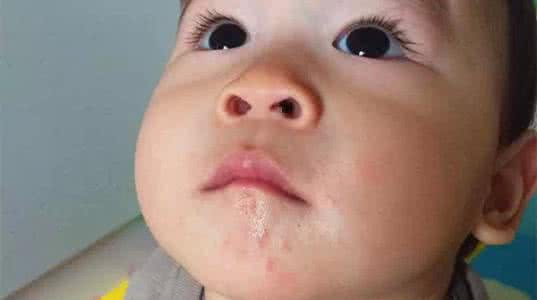 有口水疹的宝宝脸部该怎么护理,婴儿什么时候流口水预防口水疹