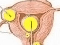 宫颈息肉可以怀孕吗,宫颈息肉怎么知道是恶性还是良性