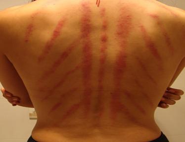 秋冬季养生扶阳除湿,肾阳虚刮痧的正确手法