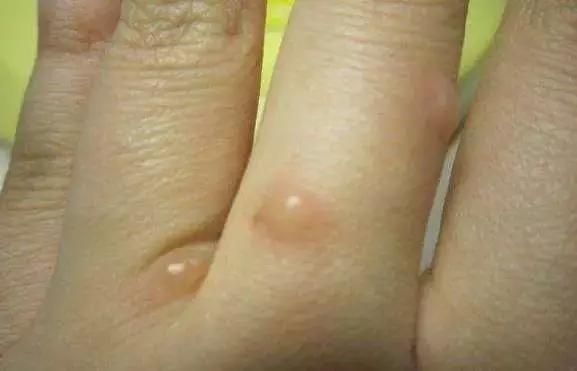 孩子身上反反复复起湿疹怎么回事,婴儿湿疹反反复复怎么治彻底