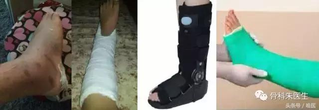 踝关节骨折和踝关节扭伤哪个严重,踝关节扭伤康复治疗注意事项