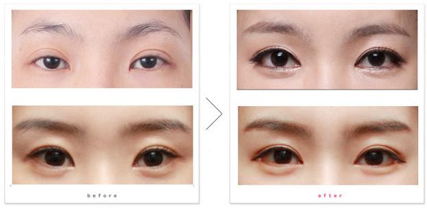 娱乐圈不老小妖精们的诀窍,玻尿酸的一二事儿~