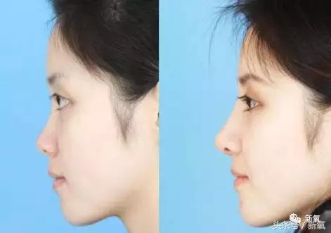 做了个达拉斯隆鼻,假体直接戳到脑门,我是不是和张檬、刘雨欣遇到了同一个医生!