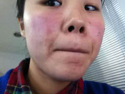 慢性湿疹吃什么止痒,治疗慢性湿疹十大中成药如何治