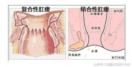 肛瘘怎么治疗好?专业医生也在看的肛瘘治疗指南