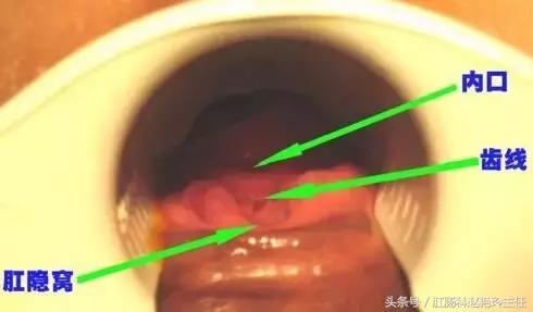 肛瘘怎么治疗好?专业医生也在看的肛瘘治疗指南