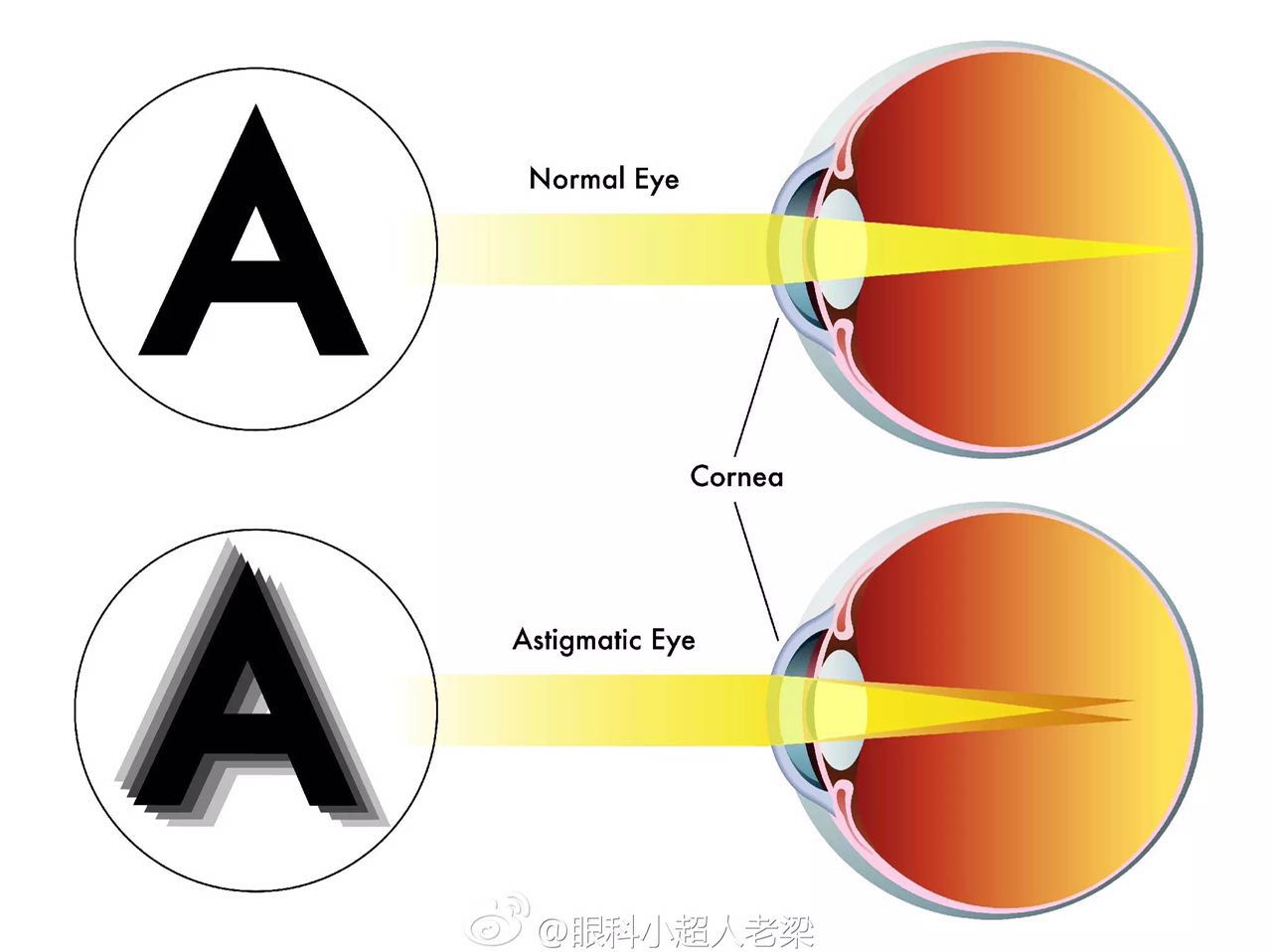 宝宝散光老母亲焦虑,孩子散光几岁治疗最好