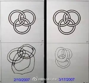 宝宝散光老母亲焦虑,孩子散光几岁治疗最好