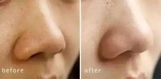 去黑头小妙招你的黑头有救了,别挤了教你去黑头的正确方法