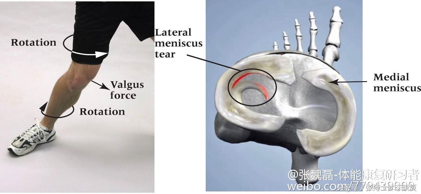 半月板的损伤怎么治疗,膝关节半月板损伤类型和缓解方法