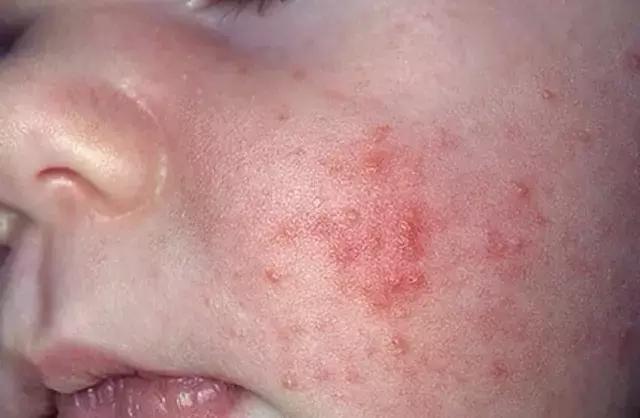 孩子身上反反复复起湿疹怎么回事,婴儿湿疹反反复复怎么治彻底