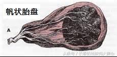 帆状胎盘能正常活动吗,帆状胎盘在胎膜上