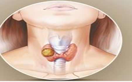 甲状腺结节4a类是癌一般能活多久,甲状腺结节怎么就变成癌了