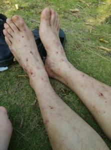 慢性湿疹吃什么止痒,治疗慢性湿疹十大中成药如何治