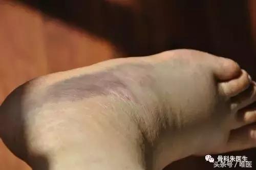 踝关节骨折和踝关节扭伤哪个严重,踝关节扭伤康复治疗注意事项