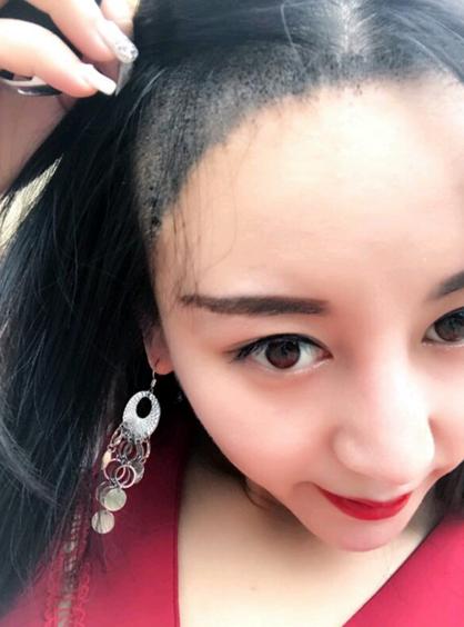 植发手术后一劳永逸了,植发做了两次以后还有毛囊可做吗