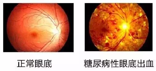 肥胖引起的血糖高怎么快速降下来,肥胖患者降血糖应该怎么做