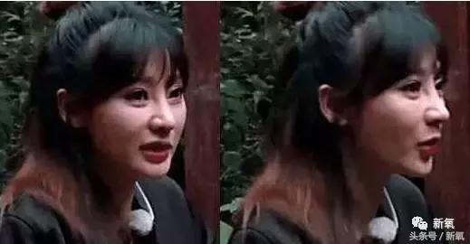 做了个达拉斯隆鼻,假体直接戳到脑门,我是不是和张檬、刘雨欣遇到了同一个医生!