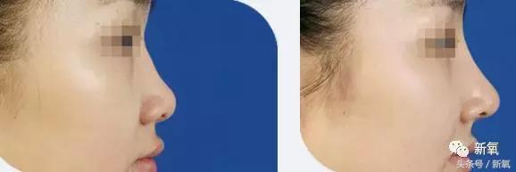 做了个达拉斯隆鼻,假体直接戳到脑门,我是不是和张檬、刘雨欣遇到了同一个医生!