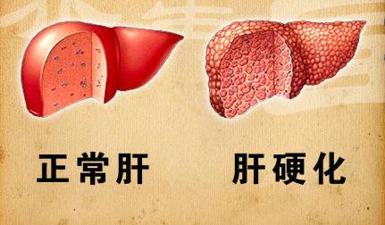 肝硬化常识大全,肝硬化断根药方
