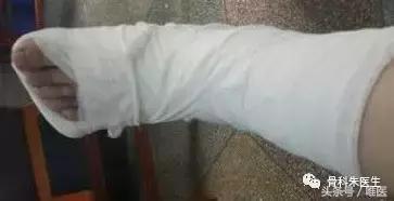 踝关节骨折和踝关节扭伤哪个严重,踝关节扭伤康复治疗注意事项