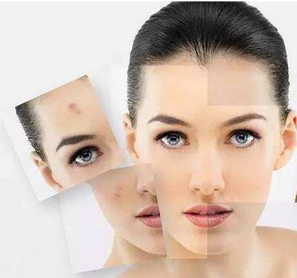 消除痘痘和痘印最简单的方法,很严重的痘痘痘印怎么消