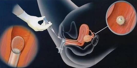 做试管婴儿的流程疼不疼,做试管婴儿全过程会痛吗