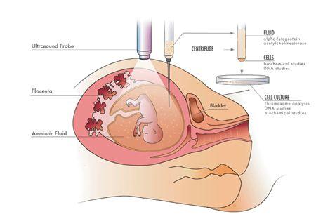 孕妈妈们羊水少怎么补才长的快,孕妈妈该如何预防羊水栓塞