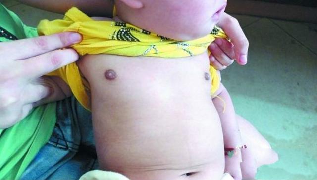 7岁多女童发现是早熟,导致7岁女童早熟原因