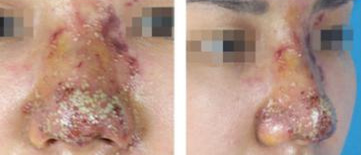 打玻尿酸隆鼻一年了鼻梁变宽,注射玻尿酸隆鼻7年还吸收不了