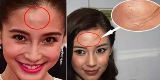 烂脸救星爆痘,烂脸救星成烂脸神器